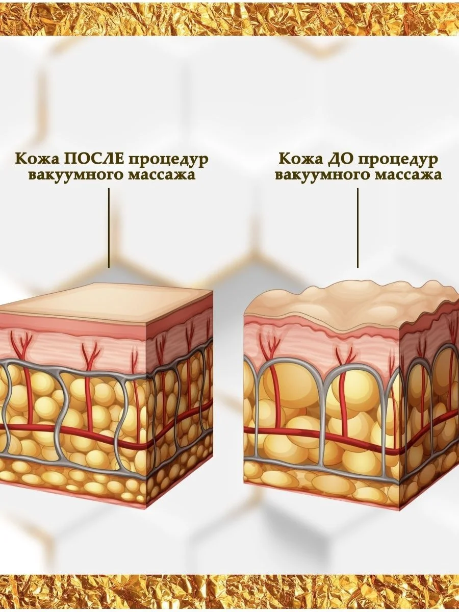 Массажер вакуумный   купить,14000